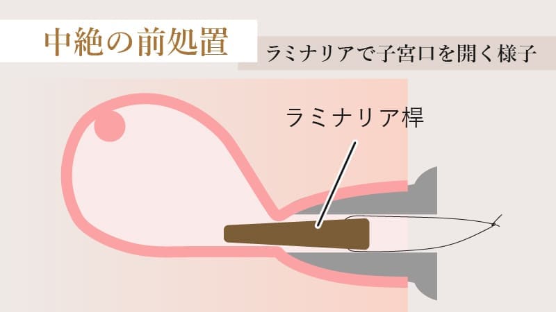 中絶の前処置についての図解