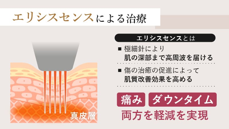 エリシスセンスは痛み・ダウンタイムともに軽減できる