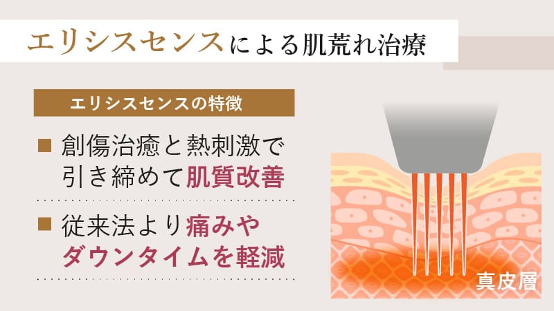 エリシスセンスは創傷治癒と熱刺激で肌質を改善し、痛みやダウンタイムも軽減できる