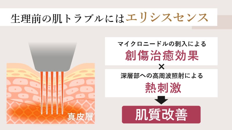 創傷治癒と熱刺激で肌質改善を図るエリシスセンス