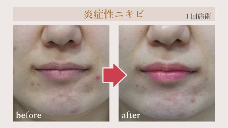 炎症性ニキビの症例（1回施術のbefore・after）