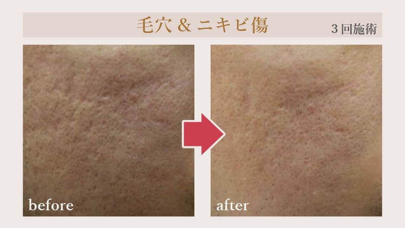 毛穴・ニキビ傷の症例（3回施術のbefore・after）