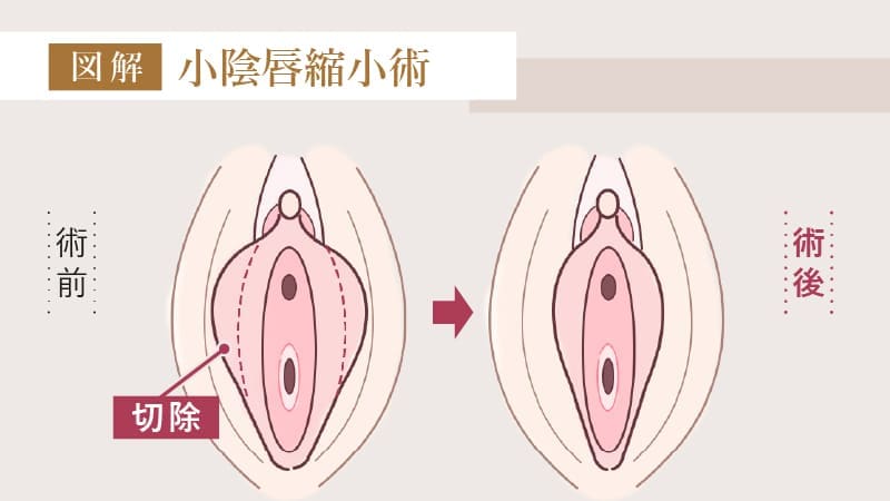 小陰唇縮小術とは？