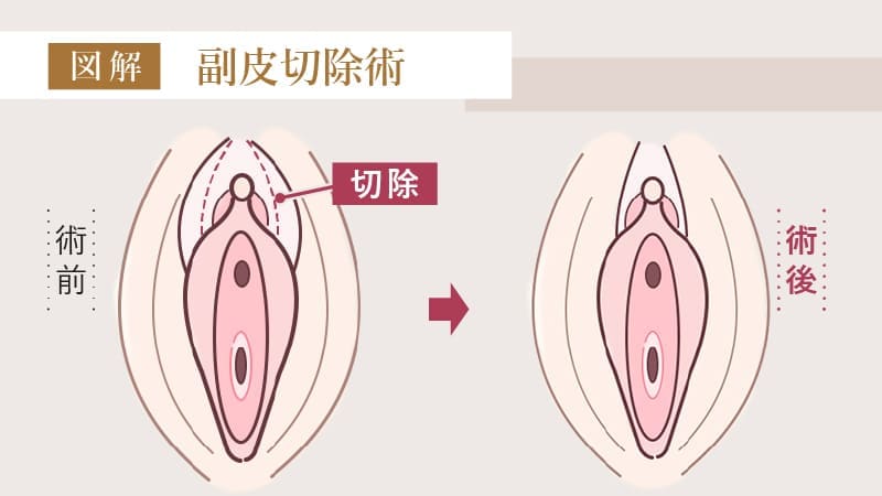 副皮切除術とは？