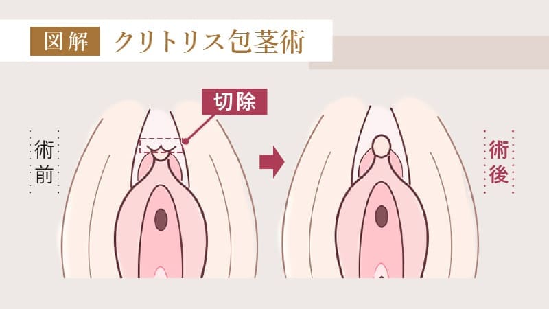 クリトリス包茎術とは？