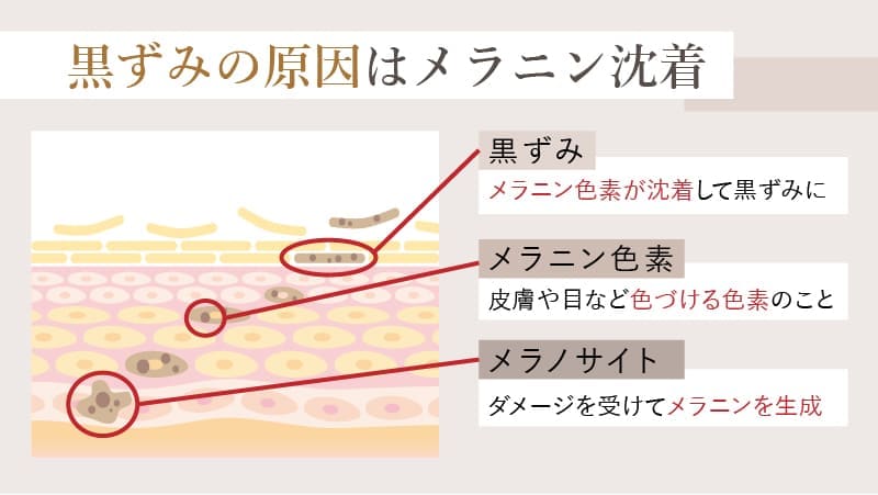 デリケートゾーンの黒ずみの原因は、メラニン色素の沈着