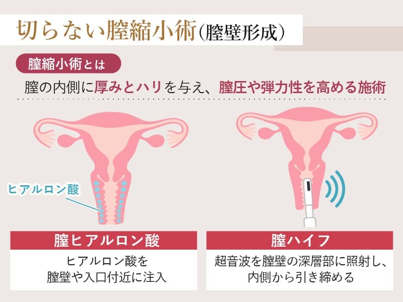 膣縮小術（膣壁形成）とは？