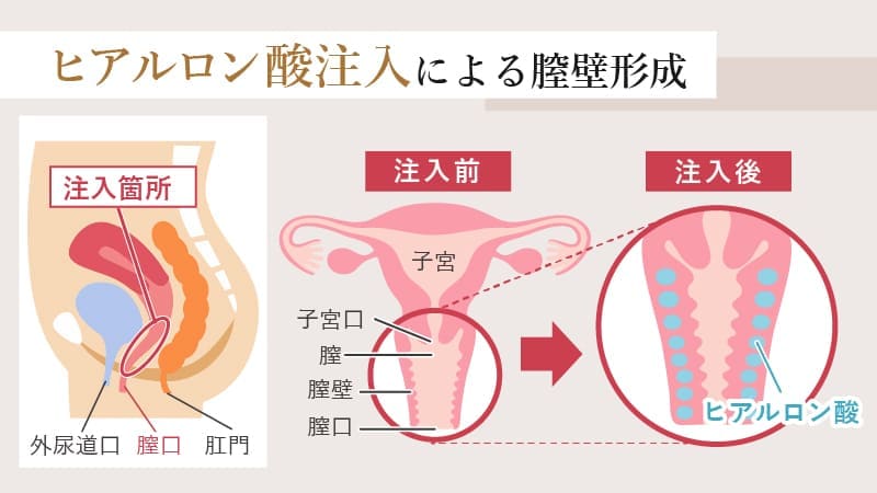 ヒアルロン酸注入による膣壁形成