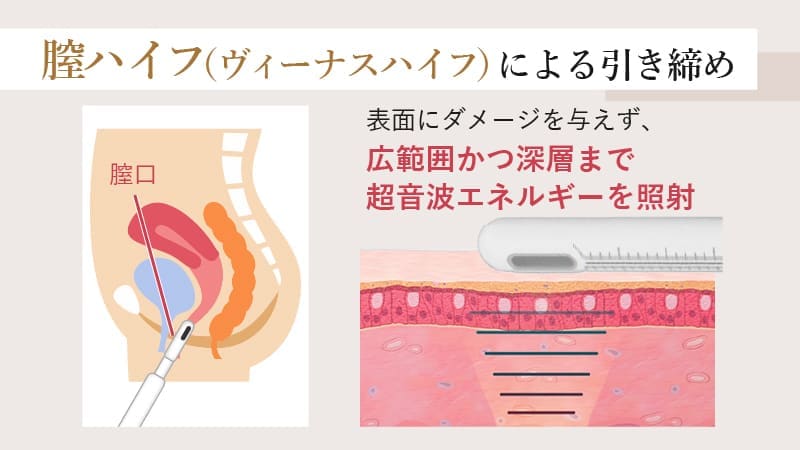膣ハイフ（ヴィーナスハイフ）による引き締め