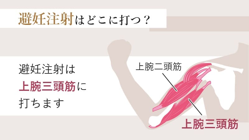 避妊注射はいつどこに打つの？