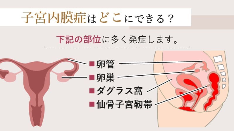 子宮内膜症はどこにできる？
