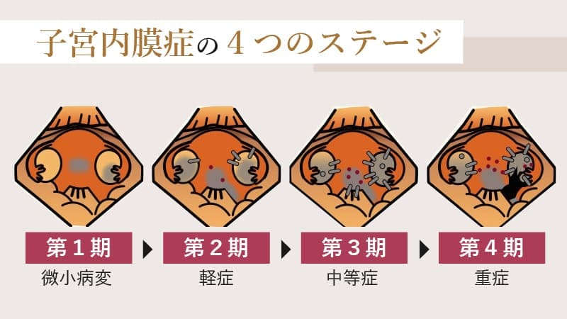 子宮内膜症の代表的な4つのステージについて